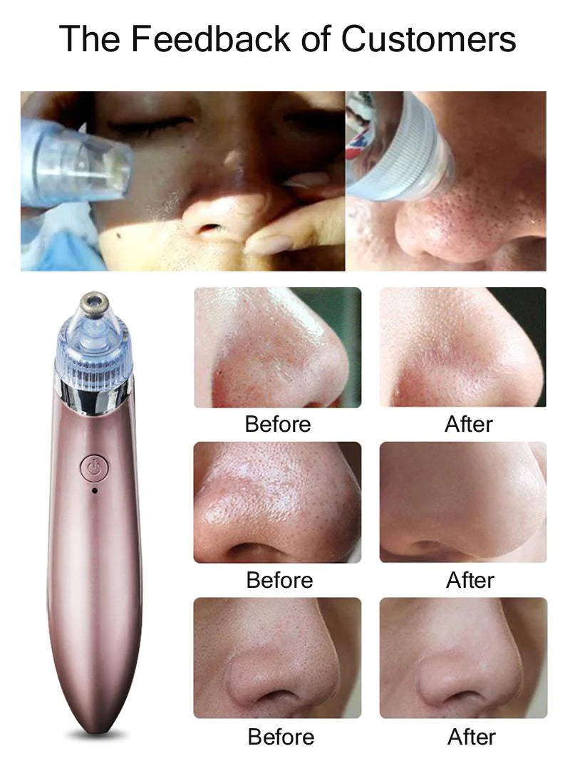 Blackhead Remover